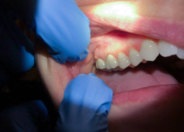 Best Emergency Treatment for Dental Infections or Abscesses in Fredericksburg, TX
