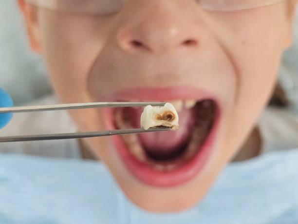 Best Emergency Tooth Extraction in Fredericksburg, TX